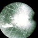 Radiation Retinopathy Radiation Retinopathy